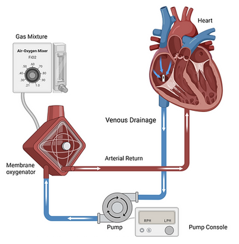 Extracorporeal Oxygenation Membrane (ECMO) circuit. Blood is pumped from the heart outside the body, through venous drainage though a pump connected with a pump console. The blood is then re-oxygenated as it is pumped through a membrane oxygenator connected to a gas mixture, and passes through arterial return back to the heart.