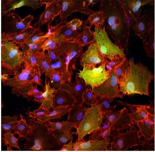 Endothelial cells expressing CD45 undergoing EndMT, as shown by co-expression of VE-cadherin (red) and αSMA (green). Nuclei stained with DAPI (blue).