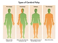 4 anatomical bodies illustrating four types of cerebral palsy