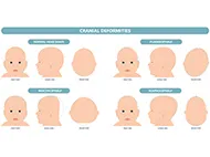 four illustrations of craniofacial anomalies 