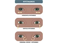 digram showing horizontal, vertical, and torsional nystagmus