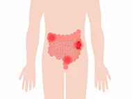 illustration of large and small intestines with blockage