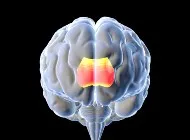 computer drawing of a human brain with the agenesis corpus lit up. 