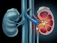 kidney with kidney stones